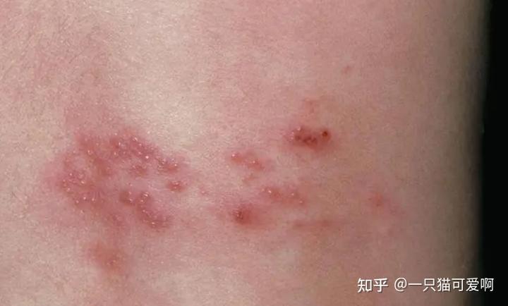 补硒能让淋巴肿大吗